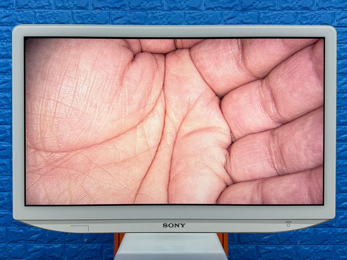 Used Smith & Nephew System Sony LED Monitor 26 Inch YOM: 2018 Smith & Nephew 660HD-E Image Management System YOM: 2021 Smith & Nephew LENS Integrated HD System YOM: 2018  Karl Storz Electronic Endoflator 264305 20  Smith & Nephew HD Camera Head 