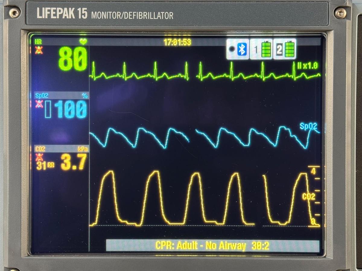 Used Includes: - Physio Control Lifepak 15 Defibrillator REF: 99577-001418 YOM: 2022 The Physio-Control LIFEPAK® 15 Defibrillator Monitor (REF: 99577-001418) is a premium advanced life support (ALS) defibrillator and patient monitoring system designed for emergency medical services (EMS), hospitals, critical care units, and ambulance providers. Manufactured by Physio-Control (Stryker), the LIFEPAK 15is one of the most trusted and widely used emergency cardiac care systems worldwide, delivering advanced monitoring, defibrillation, pacing, and diagnostic capabilities in a rugged portable platform. Designed for pre-hospital and in-hospital emergency care, the LIFEPAK 15 combines advanced cardiac monitoring technology with reliable biphasic defibrillation, helping healthcare professionals respond effectively to life-threatening cardiac emergencies. Key Features Advanced Biphasic Defibrillation Provides rapid and effective treatment for ventricular fibrillation and sudden cardiac arrest. Comprehensive Patient Monitoring Supports continuous monitoring of ECG, SpO2, NIBP, EtCO2, and other vital parameters depending on configuration. Manual, AED & Pacing Functions Offers flexible treatment options for advanced life support and emergency response applications. Large High-Resolution Display Provides clear visibility of patient data, waveforms, and critical monitoring information. Rugged EMS Design Engineered for ambulance services, emergency departments, critical care transport, and demanding clinical environments. Trusted Worldwide Widely utilized by hospitals, EMS providers, military organizations, and emergency response teams. Technical Specifications Manufacturer: Physio-Control (Stryker) Model: LIFEPAK® 15 Reference Number: 99577-001418 Device Type: Defibrillator Monitor Technology: Biphasic Defibrillation Application: Emergency Cardiac Care & Advanced Life Support Operation Modes: Manual Defibrillation, AED, Monitoring & Pacing Applications Emergency Medical Services (EMS) Ambulance Services Emergency Departments Critical Care Transport Intensive Care Units (ICU) Cardiac Care Units (CCU) Hospital Resuscitation Teams Fire & Rescue Services Military Medical Units Key Benefits Advanced cardiac monitoring capabilities Reliable biphasic defibrillation technology Portable and rugged construction Ideal for pre-hospital and hospital use Supports advanced life support protocols Trusted by emergency care professionals worldwide Proven performance in critical care environments Why Choose the LIFEPAK® 15 Defibrillator? The Physio-Control LIFEPAK® 15 Defibrillator Monitor REF: 99577-001418 is one of the industry's leading ALS defibrillator and monitoring systems, offering advanced patient monitoring, dependable defibrillation performance, and exceptional durability. It remains a preferred choice for healthcare providers seeking a reliable emergency cardiac care solution. The Physio Control Lifepak 15 Defibrillator is a reliable piece of equipment designed for advanced medical response situations. Manufactured in 2022, this model, REF 99577-001418, is used but maintains a dependable performance for emergency care. Known for its rugged design, the Lifepak 15 ensures durability in demanding environments, catering to both basic and advanced life support. Equipped with sophisticated monitoring features, the Lifepak 15 offers ECG monitoring, capnography, non-invasive blood pressure monitoring, and pulse oximetry, making it a comprehensive solution for patient management. The device also includes customizable energy protocols that aid healthcare professionals in delivering precise defibrillation therapy. Its intuitive interface and clear display facilitate quick operation and decision-making in critical scenarios. This unit remains fully functional and has been carefully inspected to ensure that it meets safety and performance standards. Ideal for hospitals and emergency medical services, the Lifepak 15 serves as a crucial tool in delivering immediate care.