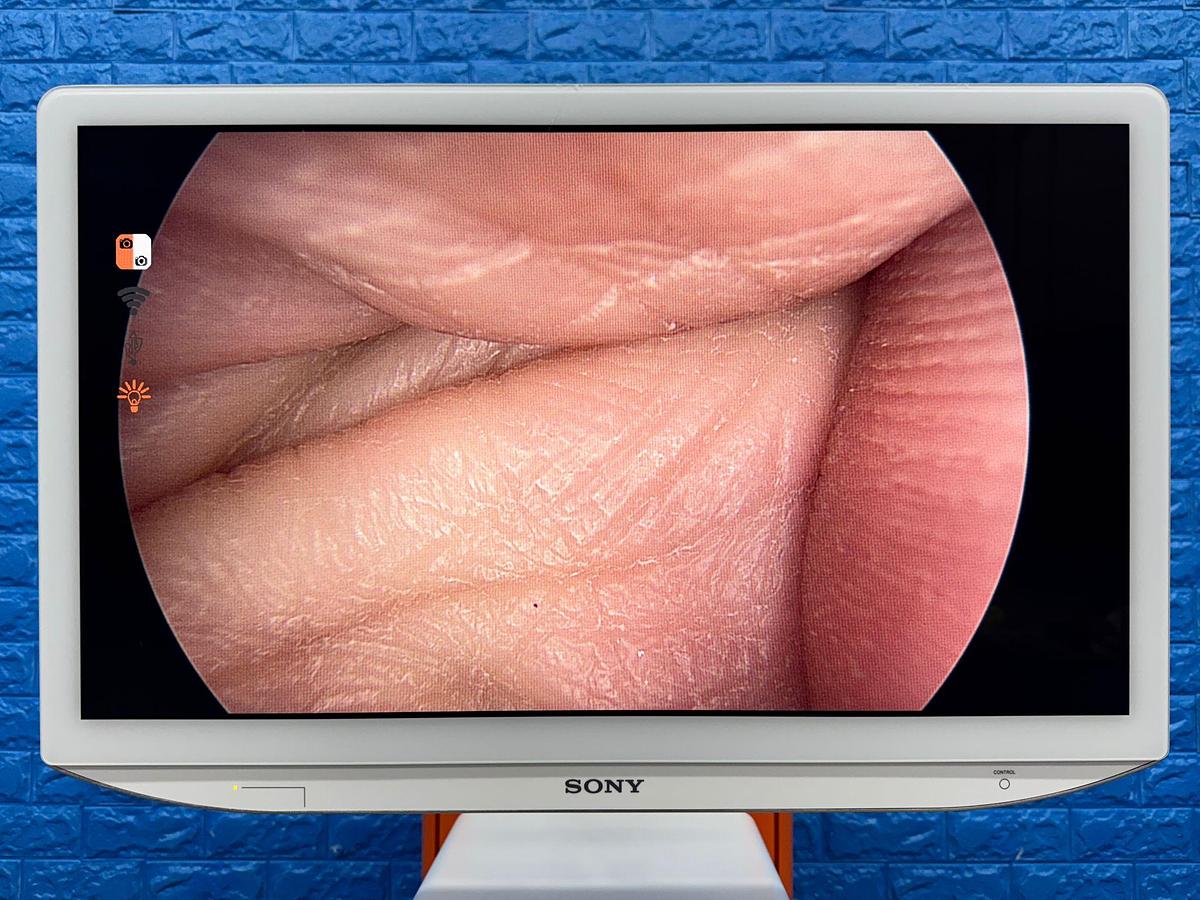 Used Smith & Nephew System Sony LED Monitor 26 Inch YOM: 2018 Smith & Nephew 660HD-E Image Management System YOM: 2021 Smith & Nephew LENS Integrated HD System YOM: 2018  Karl Storz Electronic Endoflator 264305 20  Smith & Nephew HD Camera Head 