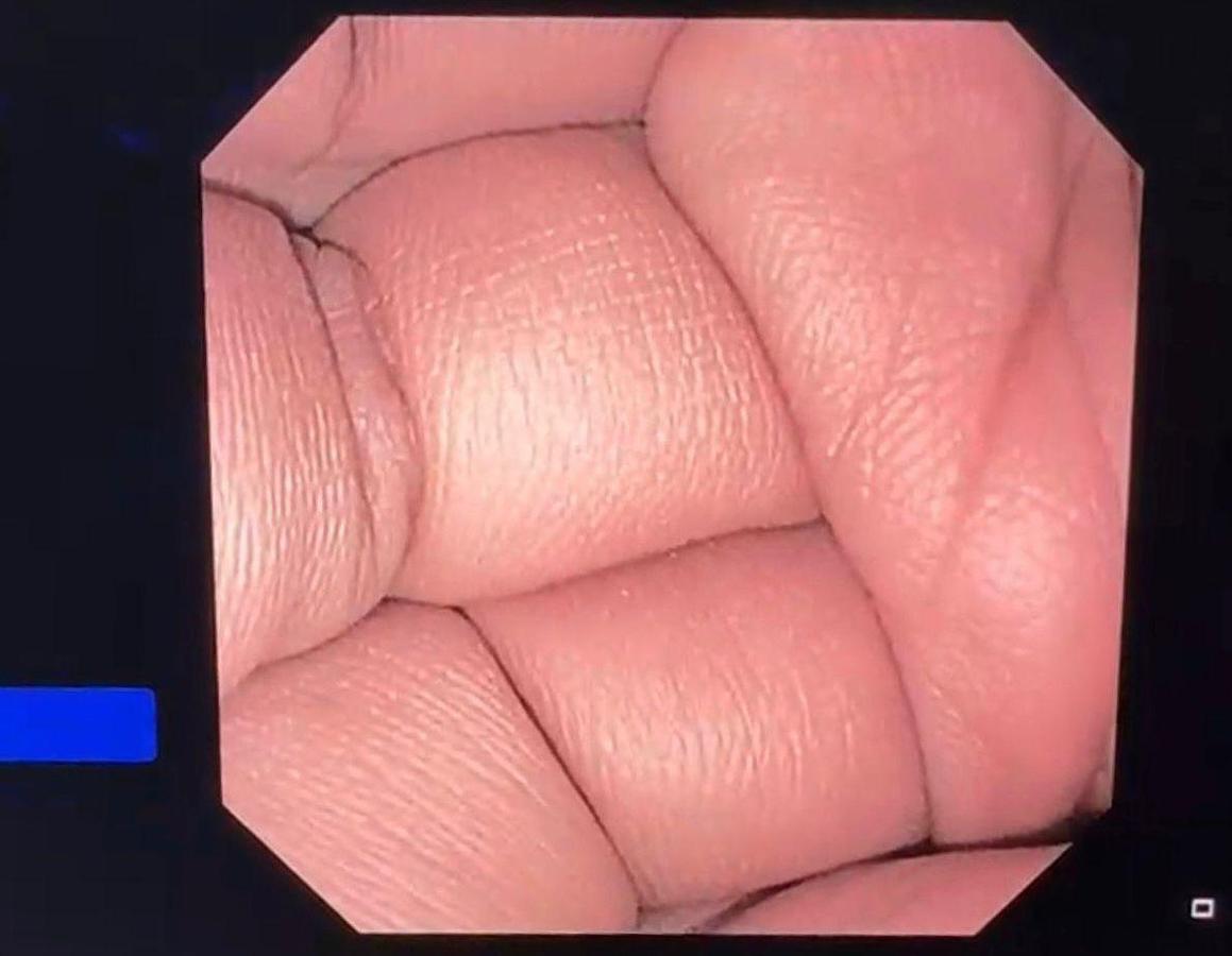 Used Olympus Scope Model: TJF-Q190V