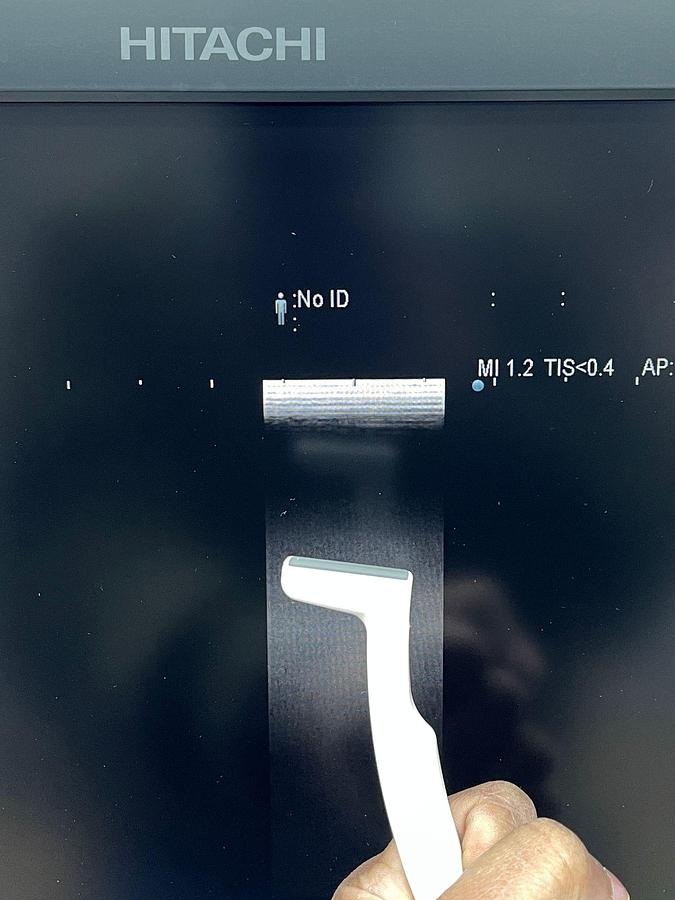 Used Hitachi Aloka Arietta V70 Ultrasound  YOM: 2016 With 5x Probes