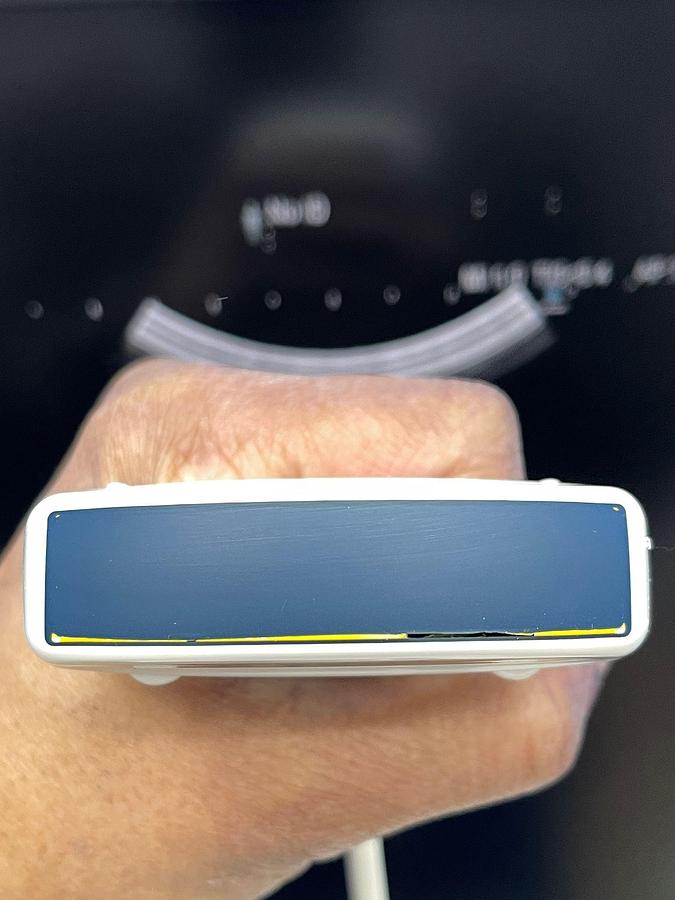 Used Hitachi Aloka Arietta V70 Ultrasound  YOM: 2016 With 5x Probes