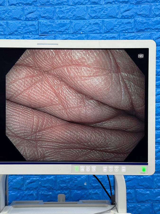 Used Olympus Evis X1 CV-1500 Endoscopy with Gastro GIF-HQ190 / Colono CF-HQ190L Includes: Olympus Evis X1 CV-1500 Processor Olympus MAJ-1921 Keyboard Olympus OFP-2 Flushing Pump Olympus UCR Gas Insufflator with hose Olympus MAJ-901 Water Bottle Olympus GIF-HQ190 Gastroscope with case and Air/Water/Suction valve Olympus CF-HQ190L Long Colonoscope with case and Air/Water/Suction valve