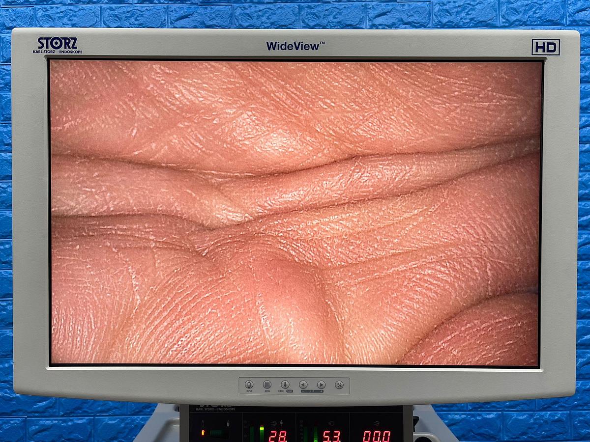 Used Karl Storz Laparoscopy Tower Karl Storz 24Inch LCD Monitor  Karl Storz Endoflator  Karl Storz Xenon 300 Karl Storz Image 1 Hub Karl Storz H3 Camera Head