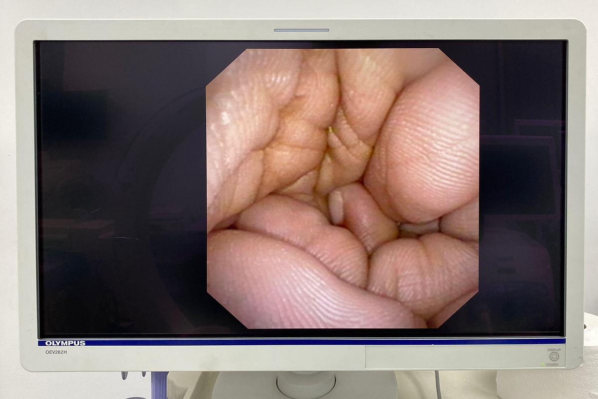 Used OLYMPUS CHF-V Choledochoscope