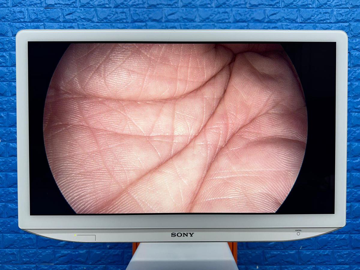 Used Smith & Nephew System Sony LED Monitor 26 Inch YOM: 2018 Smith & Nephew 660HD-E Image Management System YOM: 2021 Smith & Nephew LENS Integrated HD System YOM: 2018  Karl Storz Electronic Endoflator 264305 20  Smith & Nephew HD Camera Head 