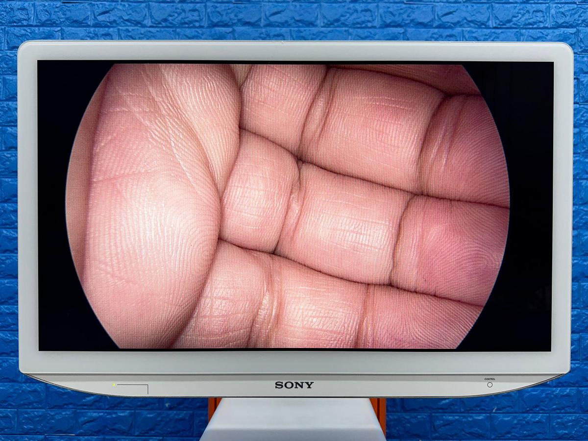 Used Smith & Nephew System Sony LED Monitor 26 Inch YOM: 2018 Smith & Nephew 660HD-E Image Management System YOM: 2021 Smith & Nephew LENS Integrated HD System YOM: 2018  Karl Storz Electronic Endoflator 264305 20  Smith & Nephew HD Camera Head 