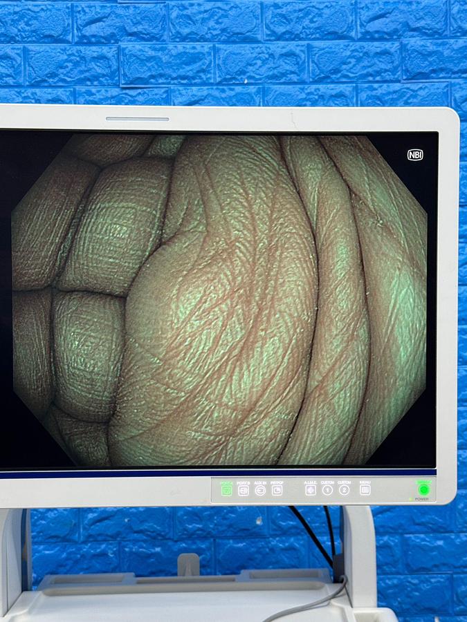 Used Olympus Evis X1 CV-1500 Endoscopy with Gastro GIF-HQ190 / Colono CF-HQ190L Includes: Olympus Evis X1 CV-1500 Processor Olympus MAJ-1921 Keyboard Olympus OFP-2 Flushing Pump Olympus UCR Gas Insufflator with hose Olympus MAJ-901 Water Bottle Olympus GIF-HQ190 Gastroscope with case and Air/Water/Suction valve Olympus CF-HQ190L Long Colonoscope with case and Air/Water/Suction valve