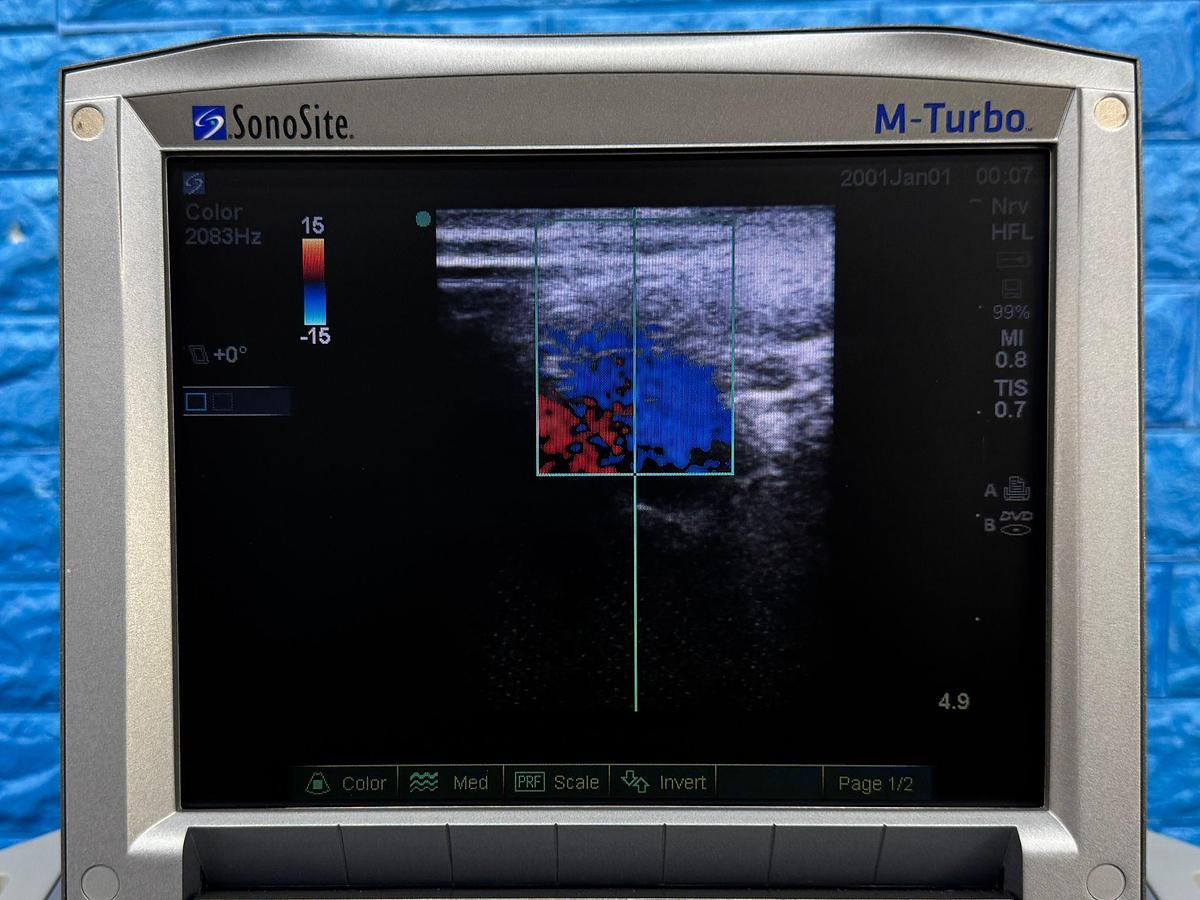 Used SonoSite Fujifilm M-Turbo Ultrasound REF: P08189-45 YOM: 2010 Probe HFL38x/13-6 MHz REF: PO7682-20 YOM: 2010