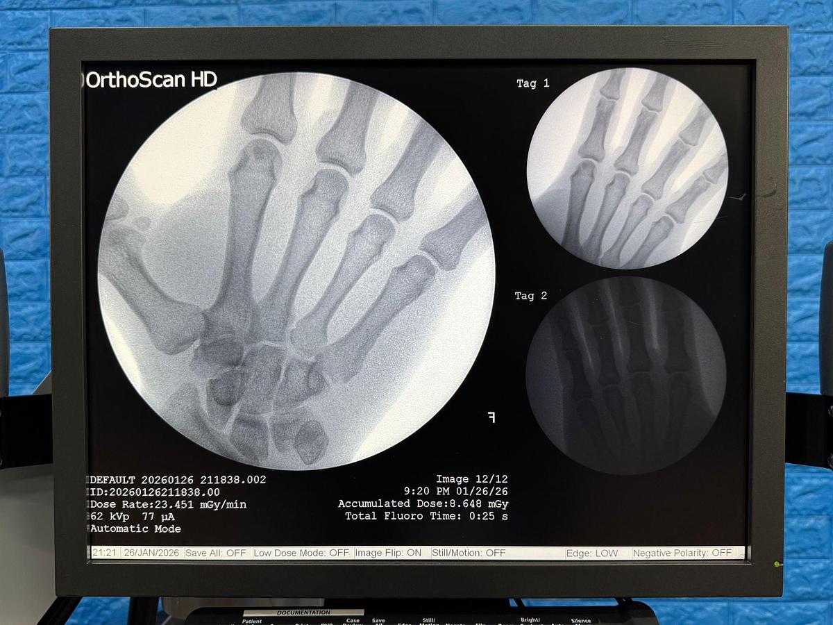 Used OrthoScan High Definition Mini C-Arm X-Ray Model: 1000-0004 YOM: 2011 SN: 5E1155