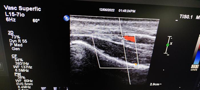 Gebraucht  Philips L15-7io Ultraschallsonde