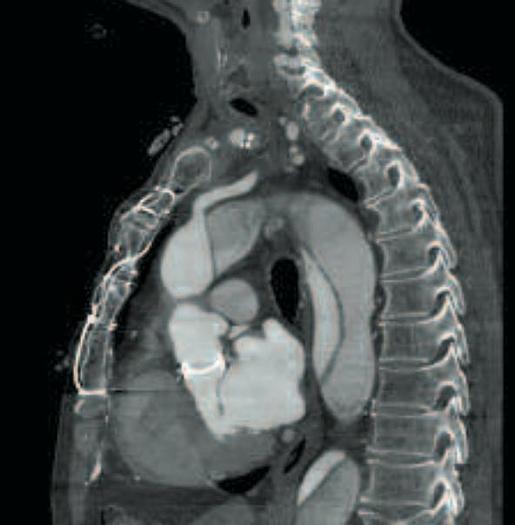 Reformado 2005 General Electric (GE) LightSpeed VCT