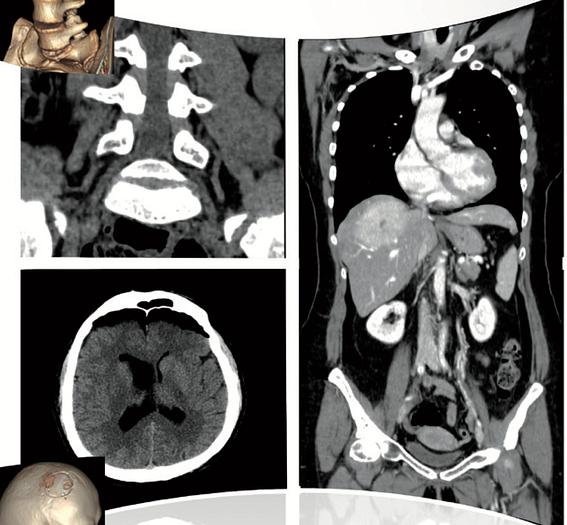 Refurbished 2003 General Electric (GE) LightSpeed