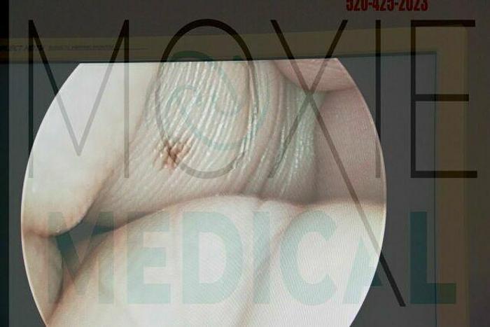 Used R WOLF PandView Plus Autoclave 25 Degree 4mm Hysteroscope 8654.402 by Richard Wolf