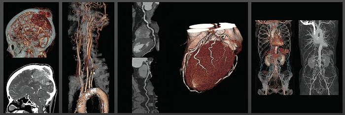 Used 2015 Toshiba Aquilion Prime