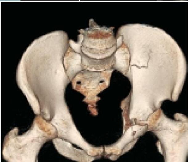 Reformado 2005 General Electric (GE) LightSpeed VCT