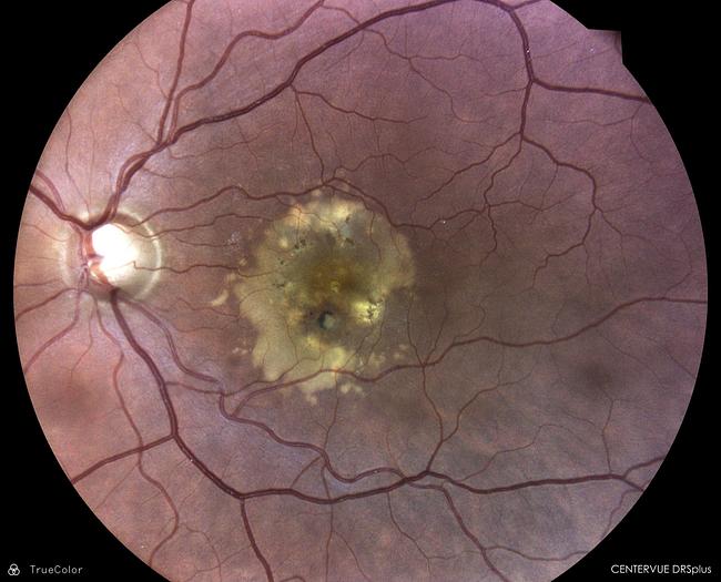 Refurbished Icare/ Centervue DRSplus Retinal Camera