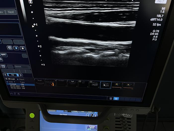 Used Ultraschallgerät Aplio 400 mit 3x Sonden und Printer