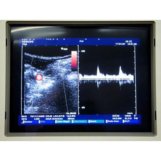 Used ECHOGRAPHE HITACHI EUB-6500 AVEC 2 SONDES