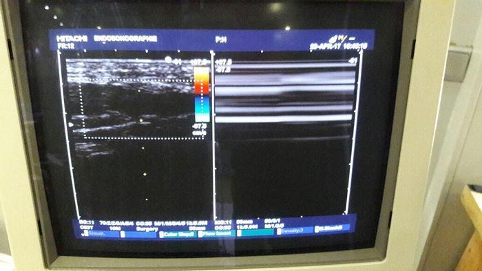 Used Hitachi EUP-053T Intraoperative Ultraschallsonde