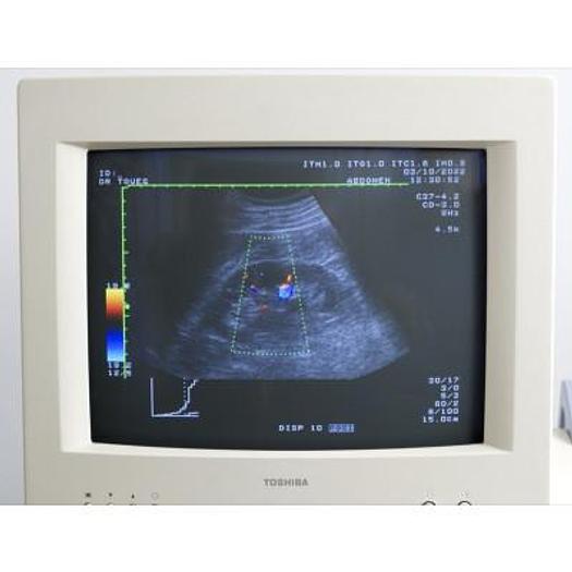 Used ECHOCARDIOGRAPHE TOSHIBA POWERVISION 6000 AVEC 3 SONDES