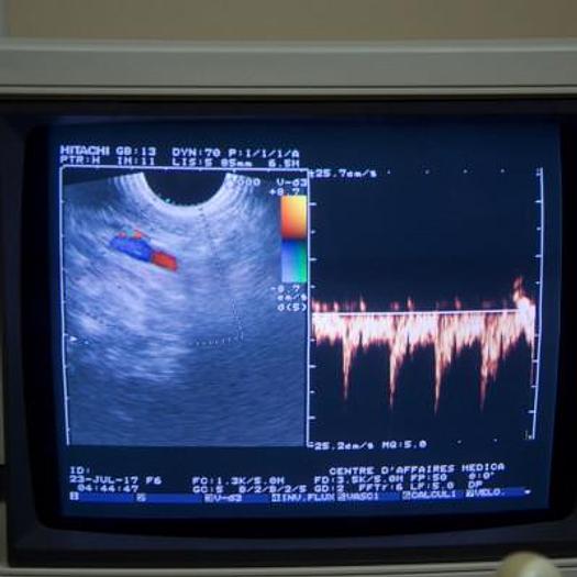D'occasion ECHOGRAPHE DOPPLER HITACHI ODYSSEE AVEC 3 SONDES