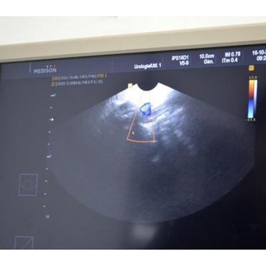 D'occasion ECHOGRAPHE MEDISON ACCUVIX  V20 AVEC SONDE CONVEXE ABDOMINALE 3D/4D VOLUMIQUE ET SONDE ENDOVAGINALE