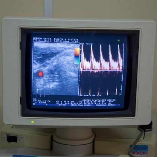 D'occasion ECHOGRAPHE DOPPLER HITACHI ODYSSEE AVEC 3 SONDES