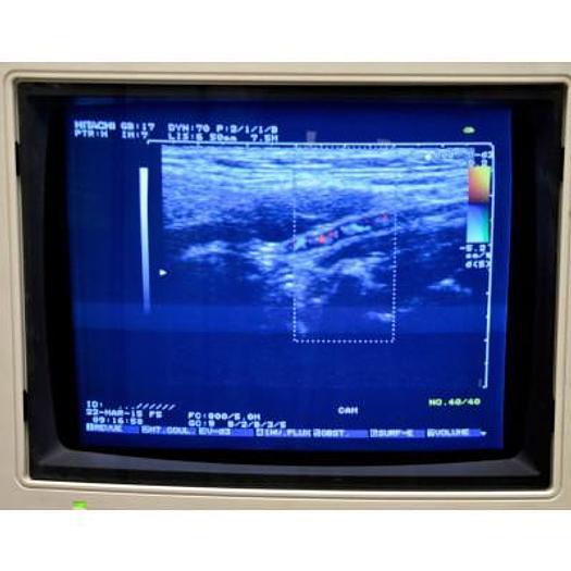 D'occasion ECHOGRAPHE HITACHI KATANA 5 COULEUR DOPPLER AVEC 3 SONDES