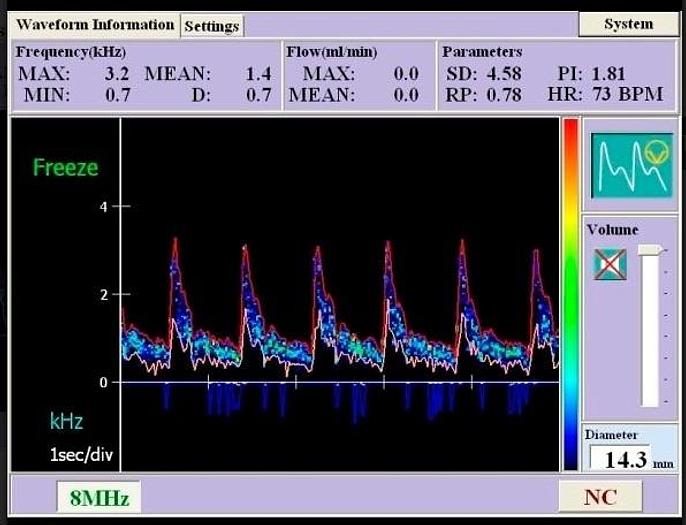Hadeco DVM-4500 Bidirektionaler Doppler