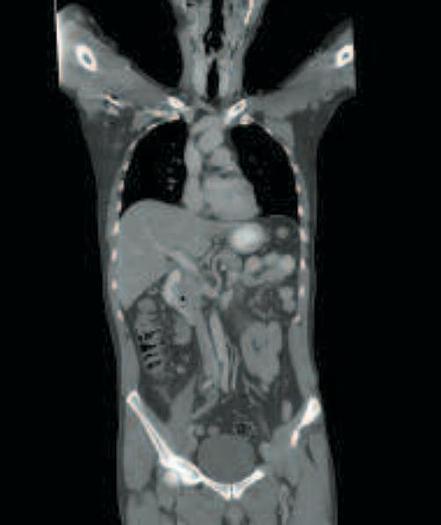 Refurbished 2010 General Electric (GE) LightSpeed VCT