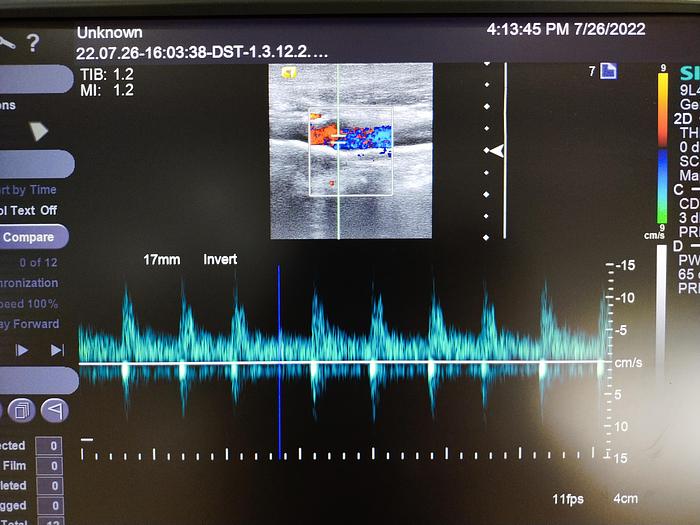 Gebraucht Siemens Acuson S2000 Ultraschallgerät mit Sonde, Farbdrucker und DVD Brenner
