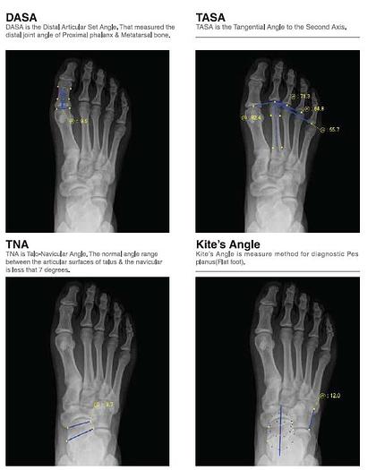 Used Rayence X-Cel 715BDXC Podiatry X-Ray