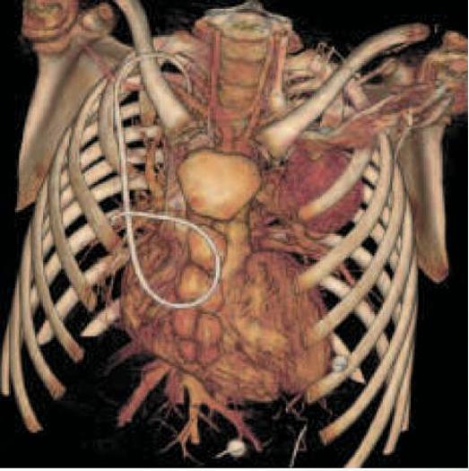 Reformado GE LightSpeed VCT