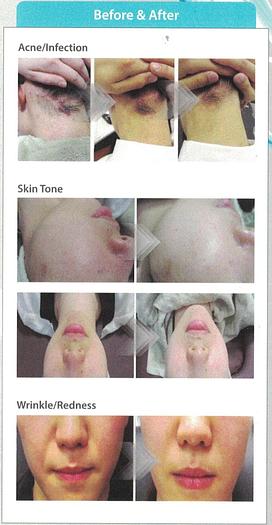 Used HydroImpact – Hydrogen Skin Care Treatment Machine