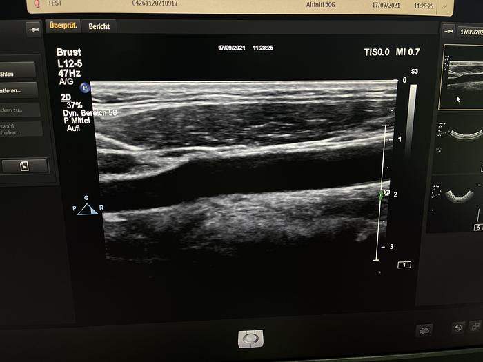 Gebraucht Philips Affiniti 50G Ultraschallgerät mit Sony Drucker