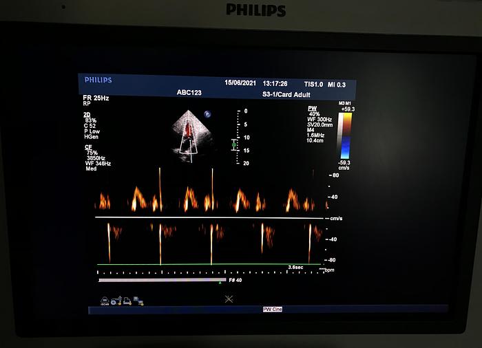 Gebraucht Philips iU22 Ultraschallgerät mit Flachmonitor, 2 Sonden, Sony Drucker