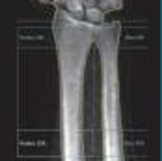 Used GE Lunar Densitometer 2012