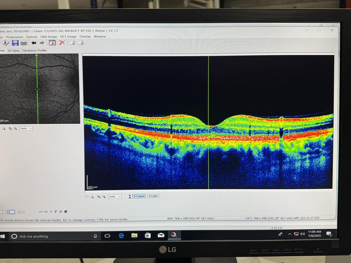 Refurbished 2011 Heidelberg  Spectralis