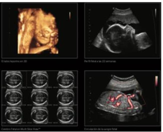 Used Samsung ultrasound SonoAce r7 Vascular