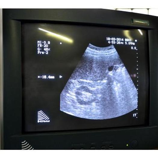 D'occasion ECHOGRAPHE NUMÉRIQUE COULEUR DOPPLER BREUEL&KJAEL HAWK 2102 EXL SWEDEN AVEC SONDE CONVEXE ABDOMINALE  MULTIFRÉQUENCE DE 2 À 6  M