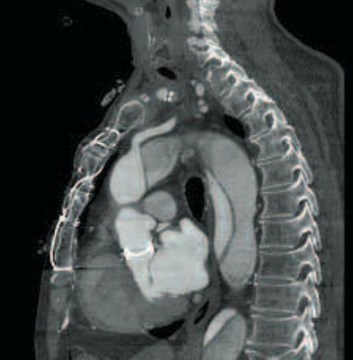 Reformado GE LightSpeed VCT