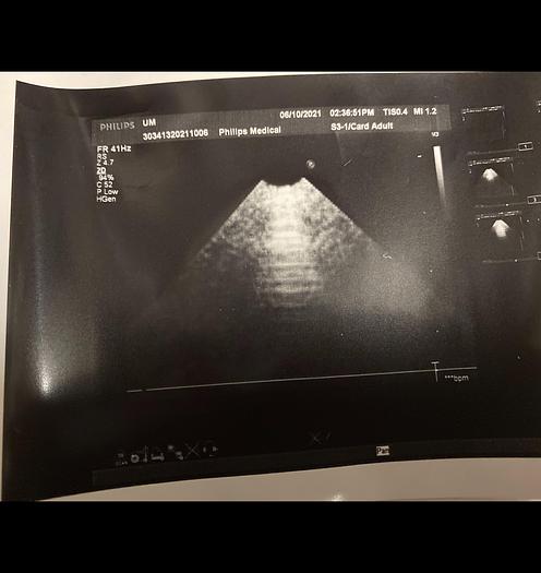 Gebraucht S3-1 philips Ultrasound probe B1RQG9