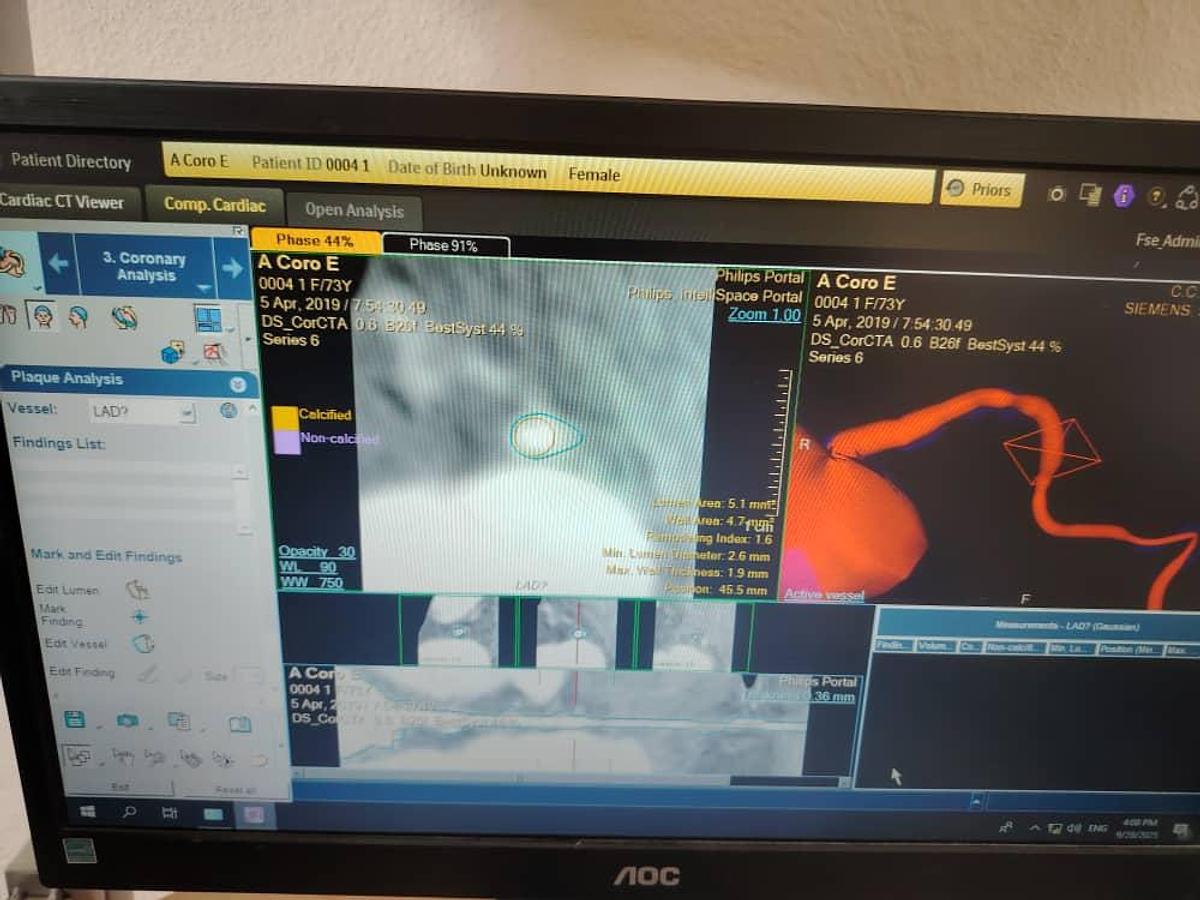 Used Philips IntelliSpace Portal V12 Multi-Modality Workstation