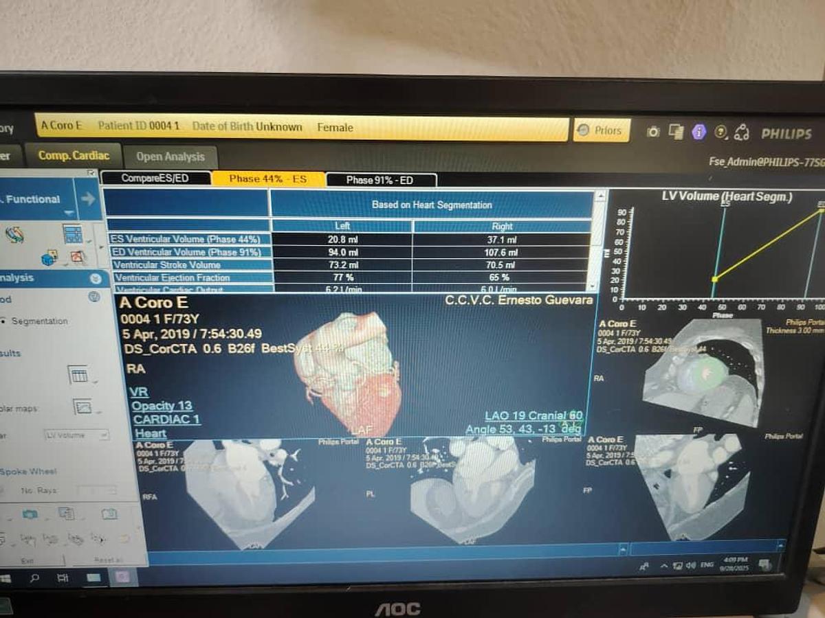 Used Philips IntelliSpace Portal V12 Multi-Modality Workstation