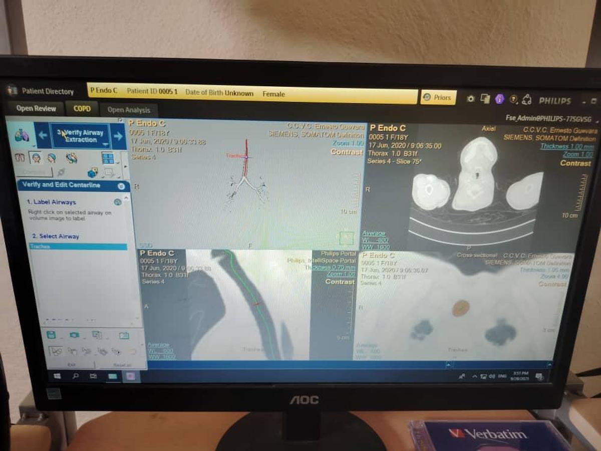 Used Philips IntelliSpace Portal V12 Multi-Modality Workstation