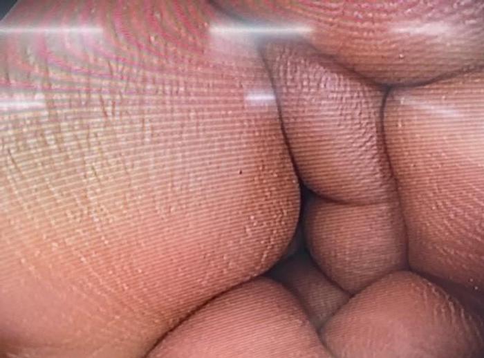 Refurbished  Olympus EXERA II CF-H180AL Video Colonoscope