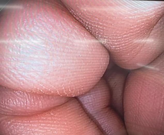 Refurbished  Olympus EXERA II CF-H180AL Video Colonoscope