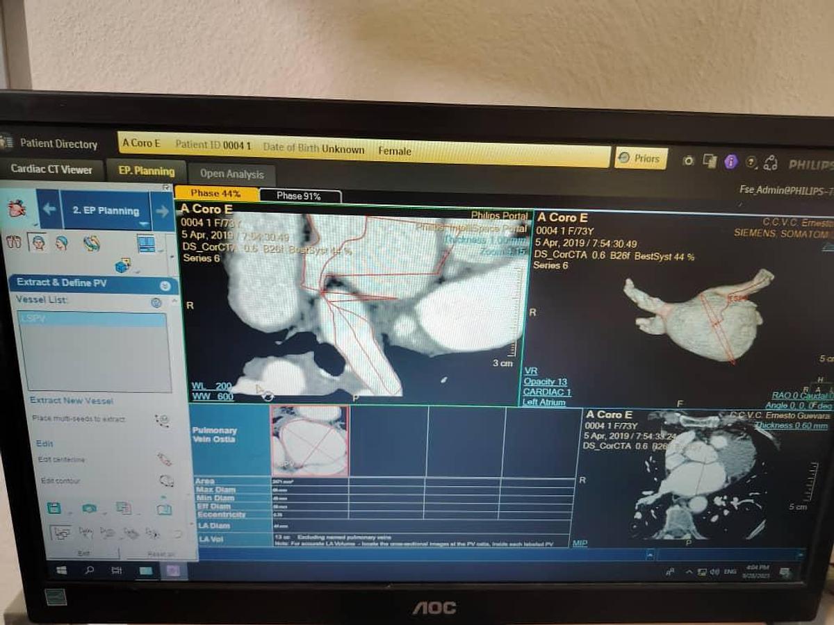 Used Philips IntelliSpace Portal V12 Multi-Modality Workstation