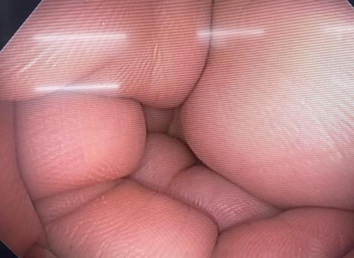 Refurbished  Olympus EXERA II CF-H180AL Video Colonoscope